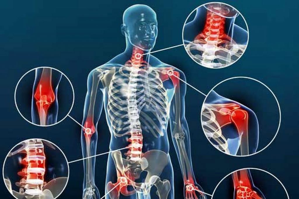 نقاط درگیر با آرتروز